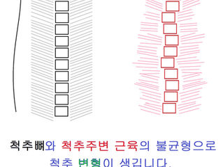 등 통증도 허리 통증과 같습니다. 척추이기 때문입니다.