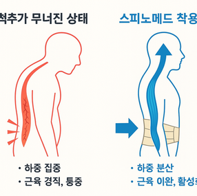 스피노메드의 장기적인 착용이 왜 중요한가?