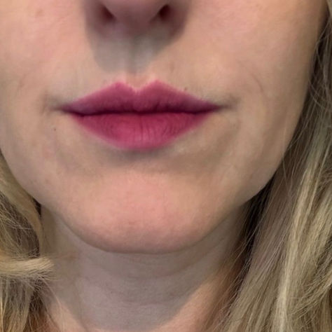 Lip Filler Aftercare