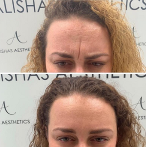 Wrinkle Treatments