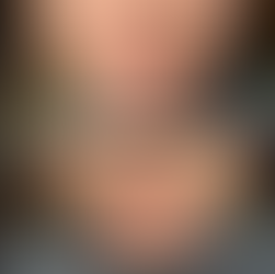 Chin Filler Treatment Southampton