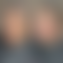 Jawline Filler Treatment Southampton