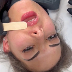 What is a Capillary Refill Test After Lip Fillers?