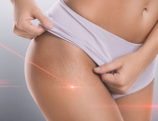 Body Laser Resurfacing