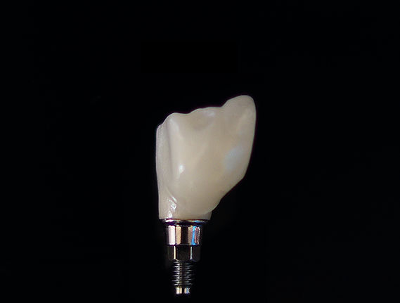 Corona sobre implante dental