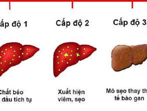 GAN NHIỄM MỠ ĐỘ 3: BÁO ĐỘNG XƠ GAN, SUY GIẢM CHỨC NĂNG GAN!