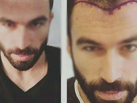 Everything That You Should Know About Hair Transplant