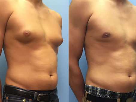 What You Need To Know About Gynecomastia?