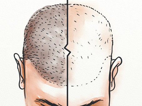 Benefits of Hair Transplant Surgery