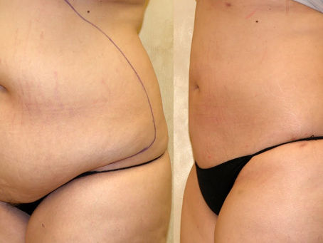 All That You Should Know About Liposuction