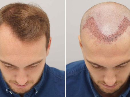 Expectations After Hair Transplant Surgery