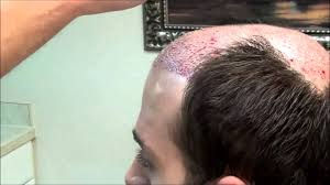 Best Guide To Hair Transplant Surgery