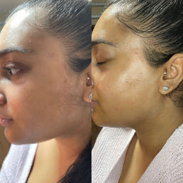 Dermaplaning