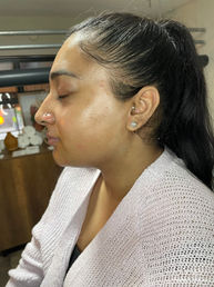 Dermaplaning