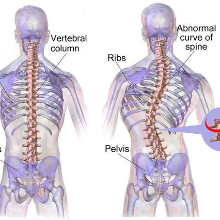 Scoliosis (Spinal Curvature) Part 2