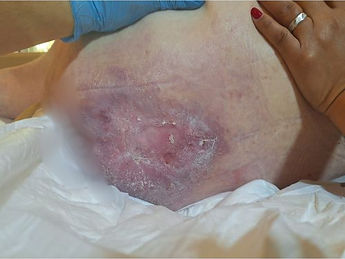 פצע לחץ דרגה 4 בגב עכוז (1).jpg