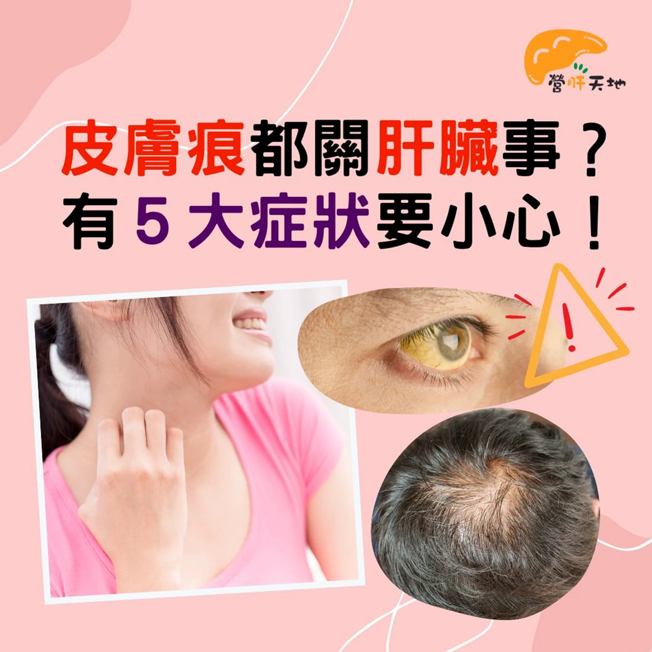 皮膚痕都關肝臟事？有５大症狀要小心！