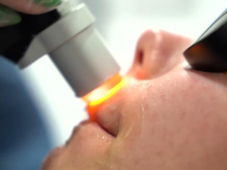 Can Erbium Peel treat acne?