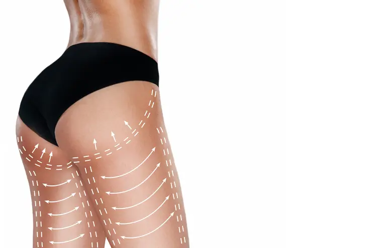 What Makes a Brazilian Butt Lift Popular for Body Shaping?