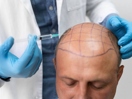 Can FUT Hair Transplant improve scalp health?