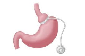 Are There Age Limits for Gastric Sleeve Surgery Candidates?