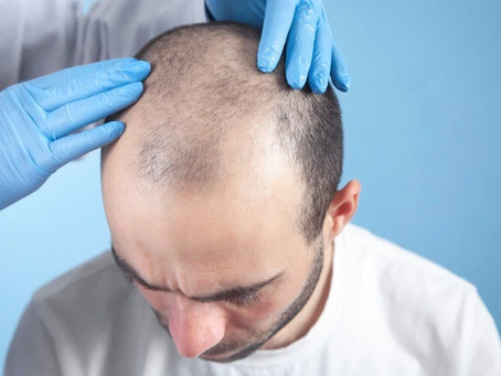 Can body hair transplant improve thin beard areas?