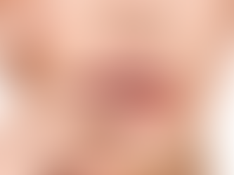 Can Juvederm Filler Enhance Facial Balance?