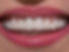 dentasya_zirconiumdental_veneers.jpeg
