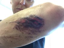 My 'ouchy' 12 stitches required... not quite what I was hoping for