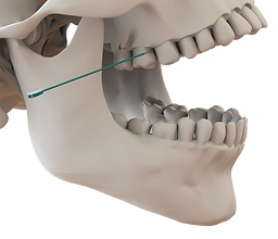 2- Needle Entering Embrasure_zoom_TG.png