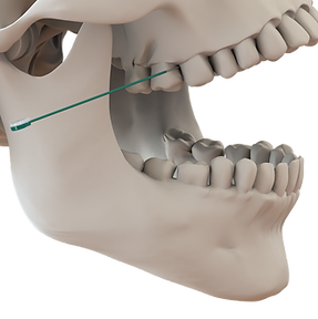 2- Needle Entering Embrasure_zoom_TG.png