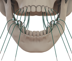 11- Front Open Engaged_IFU.png
