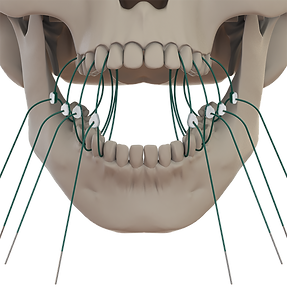 11- Front Open Engaged_IFU.png