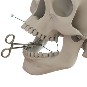 MinneTies_image_Technique_Step_06_NeedlePushingMandible.png