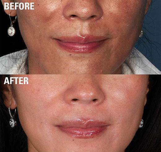 Hyperpigmentation before and after