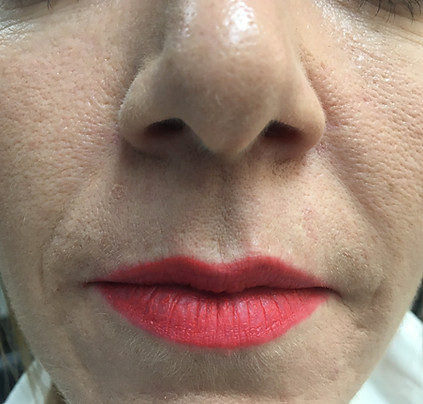 Dermal fillers