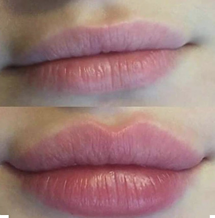 Lip fillers