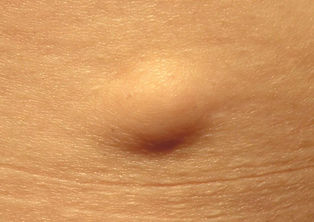Lipoma-photo.jpeg