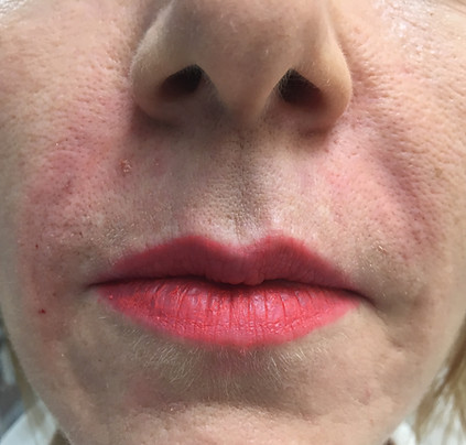 Nasolabial fold fillers, London, Harley Street