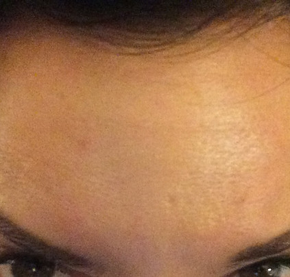 botox,wrinkle reducing injections, London, Harley Street