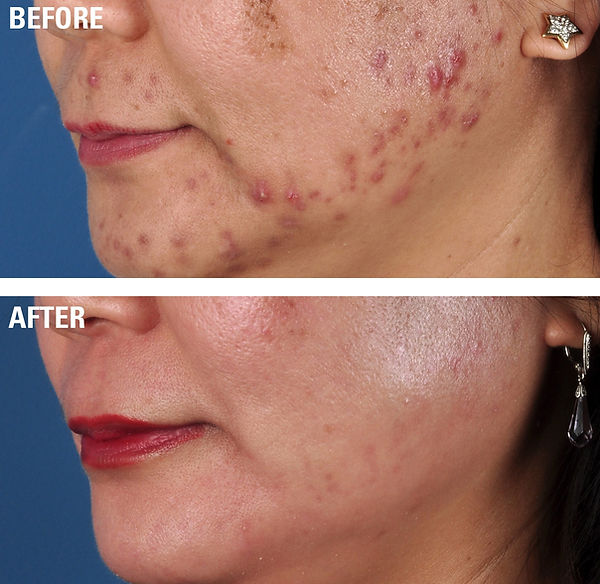 Acne treatment before and after