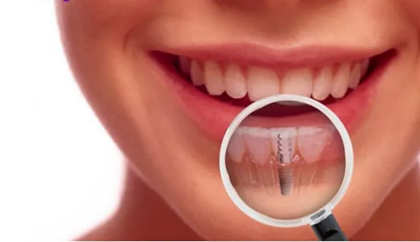 Dental Implant Turkiye Bluedent Com Tr