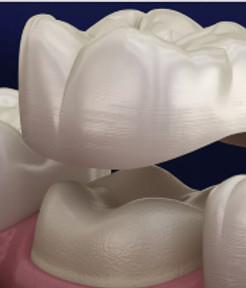 dental-crown-oakleigh-dentist_edited_edi
