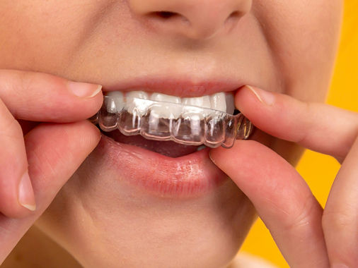 Patient inserting clear orthodontic retainer made in-house at Dental Capital SE in Oakleigh.