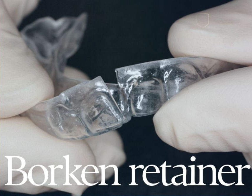 An image of cracked clear removable orthodontic retainer
