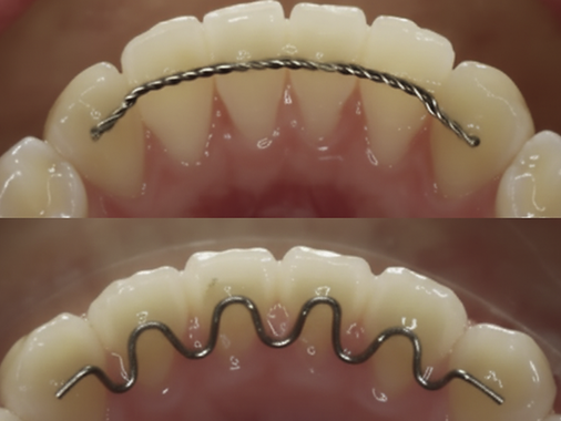 Two types of bonded orthodontic retainers: straight wire and V-loop design, both custom-made at Dental Capital SE in Oakleigh