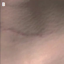 BU_Web_2503_Rejuran_Before After_B.jpg