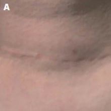 BU_Web_2503_Rejuran_Before After_A.JPG