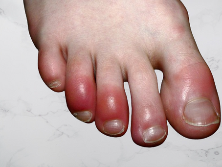 Chilblains: Symptoms, Causes & Prevention