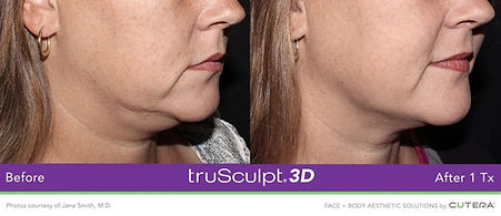 trusculpt fat reduction for chin